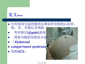 2022年醫(yī)學(xué)專題—acs腹腔間隙綜合癥-展示頁(yè)