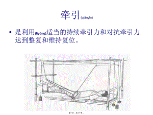 2022年醫(yī)學(xué)專(zhuān)題—如小兒股骨干骨折用垂直懸吊皮牽引(更新版)