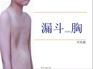2022年醫(yī)學專題—漏斗胸-ppt-免費閱讀