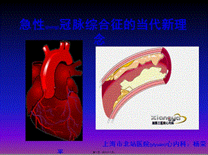 2022年醫(yī)學專題—急性冠脈綜合征當代新理念(講稿)1-閱讀頁