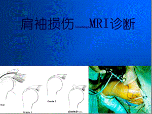 2022年醫(yī)學專題—肩關節(jié)損傷mri-在線瀏覽